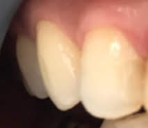 歯のホワイトニング①